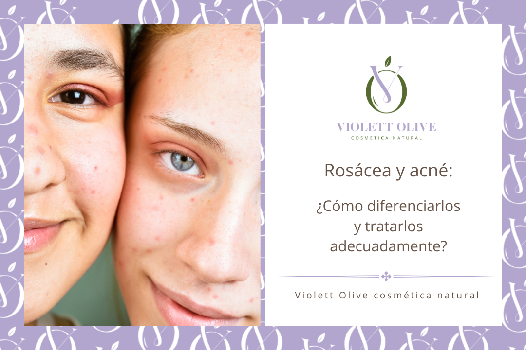 Rosácea y acné