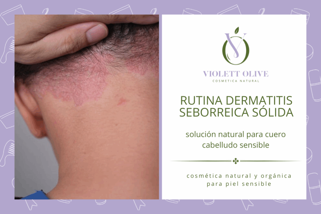 Blog Rutina dermatitis seborreica sólida: solución natural para cuero cabelludo sensible Violett Olive cosmética natural y orgánica